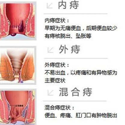 2 Boxes Zhi Shuang RuGao Zhichuang zhuanyonggao  15g / Box 痔爽乳膏痔疮专用膏